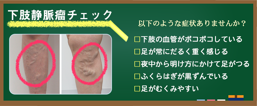下肢静脈瘤チェック